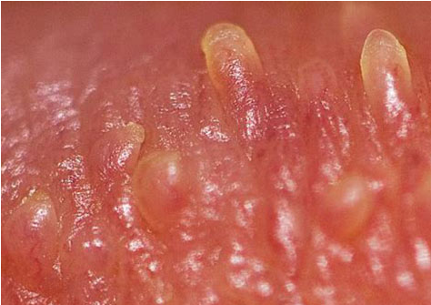男性生殖系统真菌感染症状图片