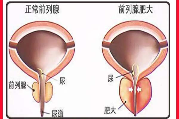 前列腺增生症状表现-前列腺增生主要症状